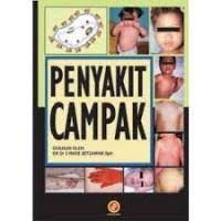 Image of Penyakit Campak